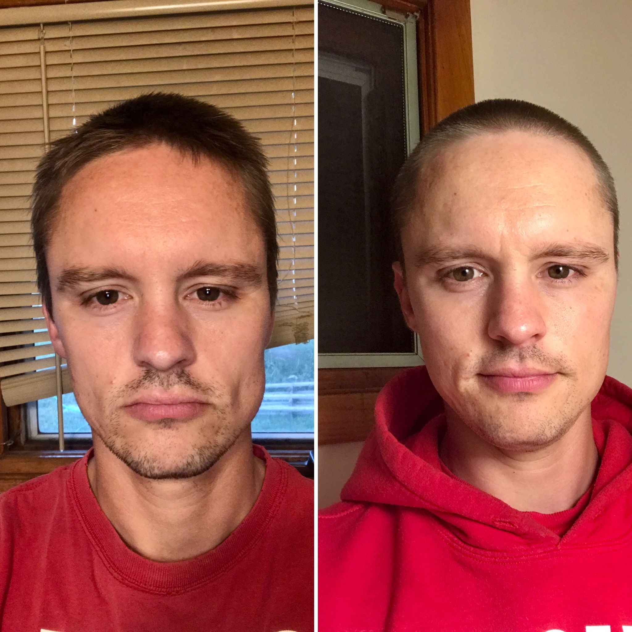 Carnivore Diet Before And After Skin