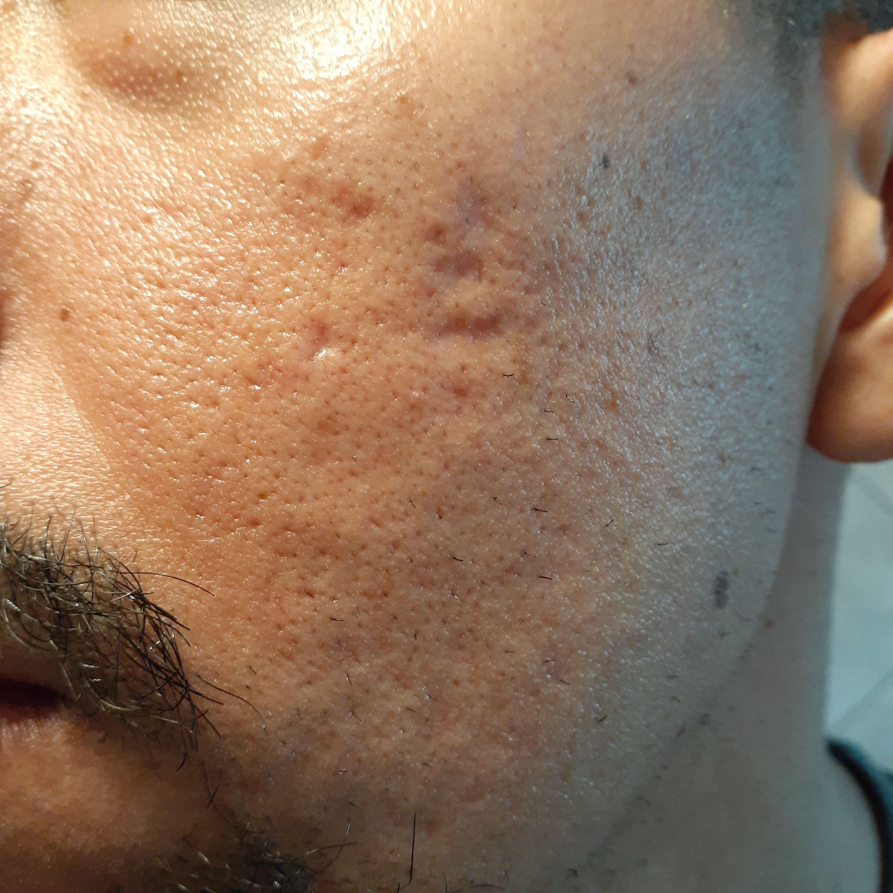 [Before/After] Excellent results at Scar Healing Institute, Beverly ...