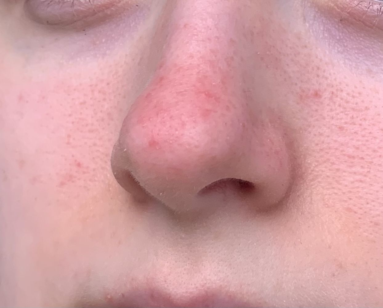 Is This Rosacea Pls Help Dermatologists Rosacea And Facial Redness