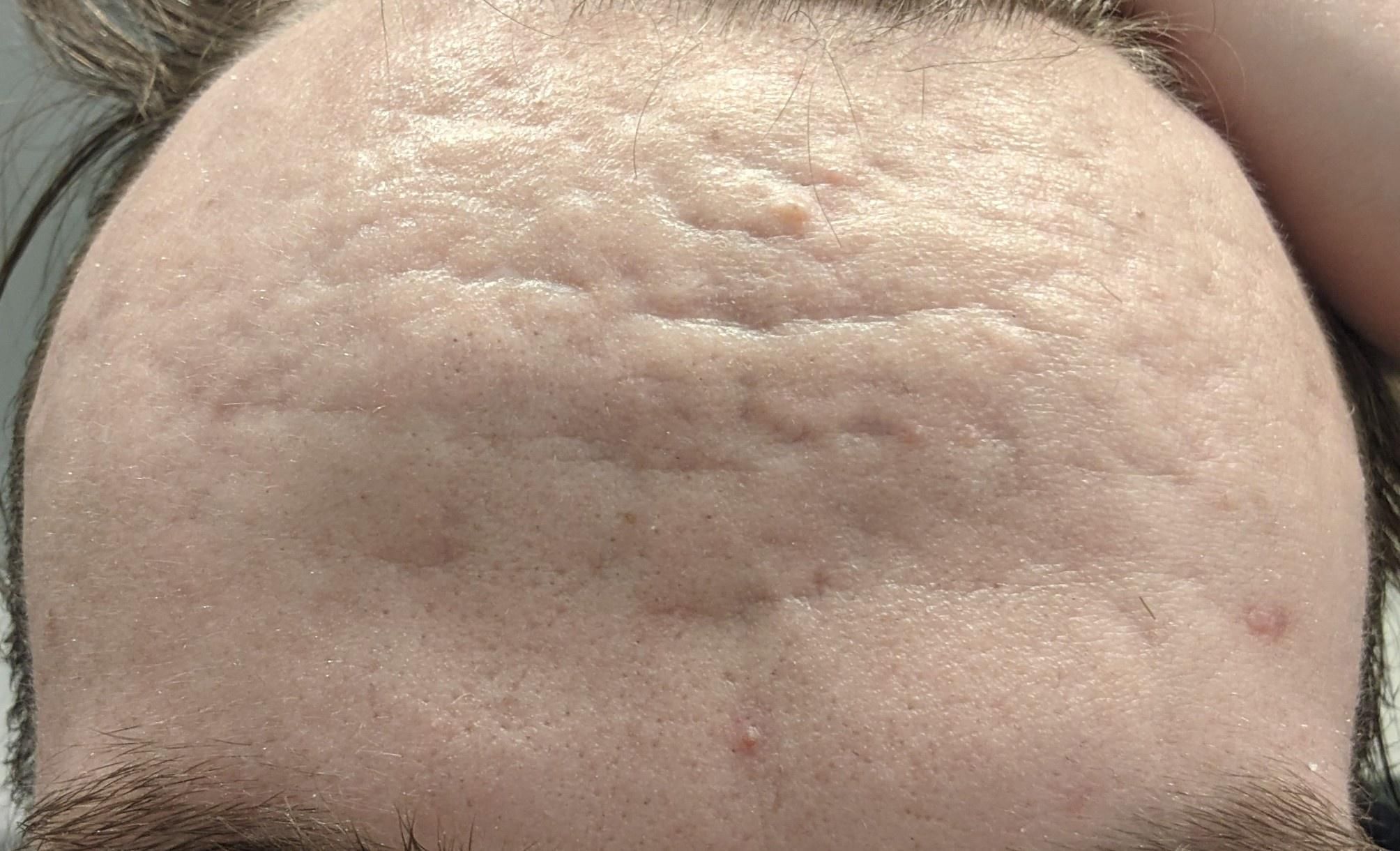 What Should I Do? Boxcar Scars Didn't Respond To CO2 And Subcision ...