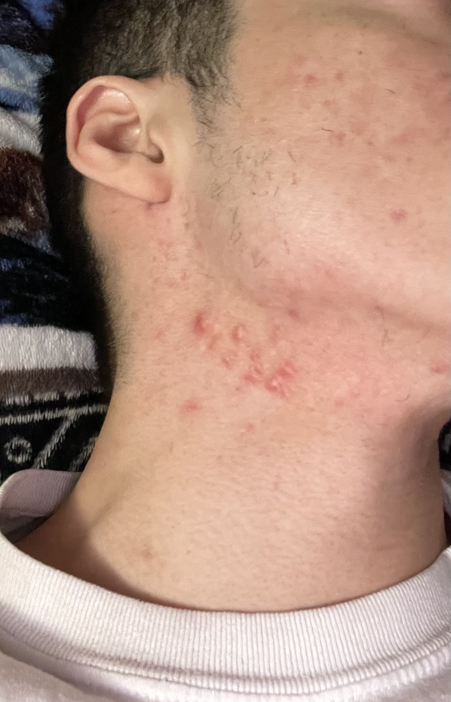 hypertrophic acne scar