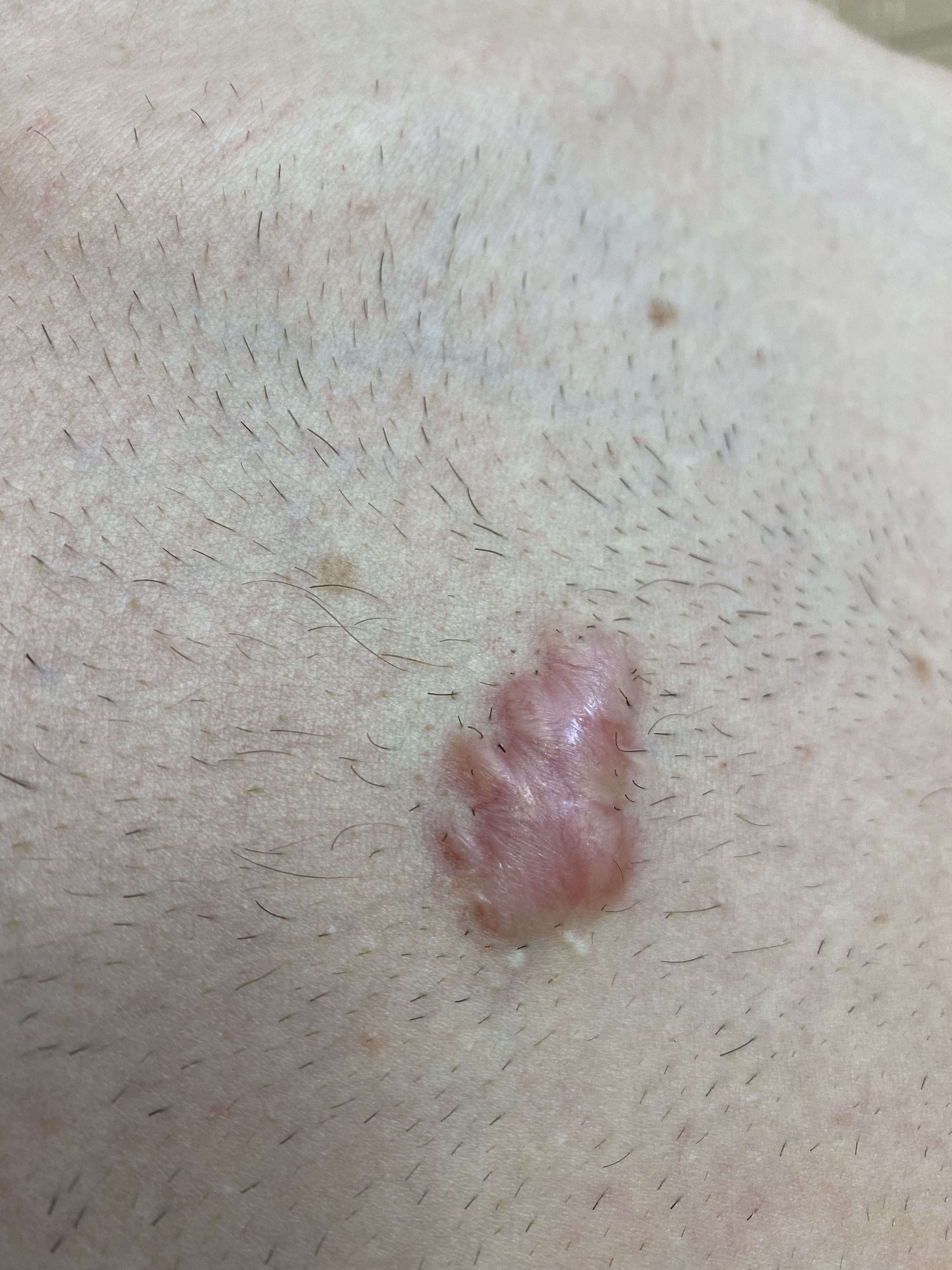 Keloid scars on chest Hypertrophic (raised) scars