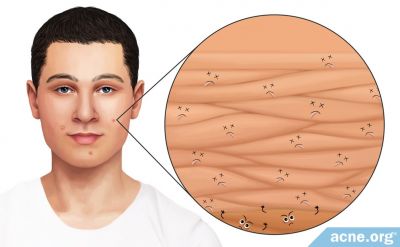 Acne In-depth: How Dead Skin Cell Accumulation Can Lead to Acne