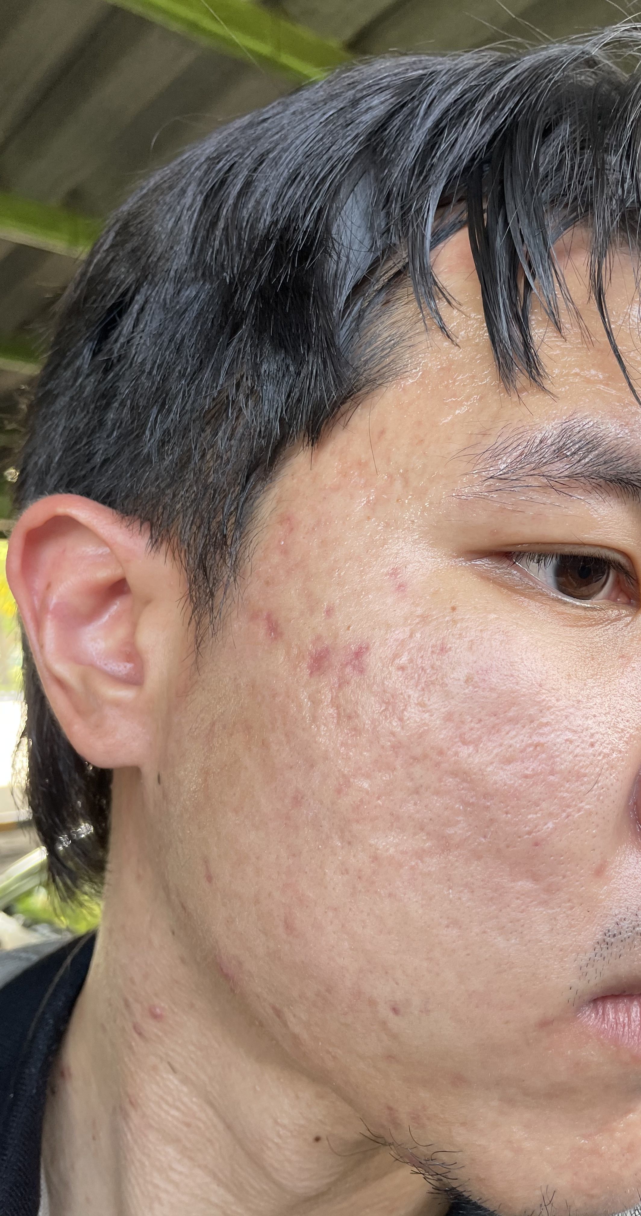 What Is The Best Treatment For My Severe Acne Scars After Finishing Or While Taking Accutane