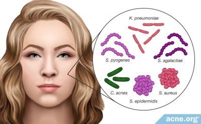Do Different Strains of Acne Bacteria Affect Acne Differently?