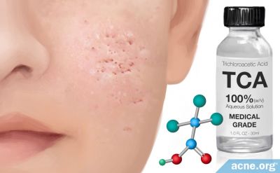 How Trichloroacetic Acid (TCA) Reduces Acne Scars (and May Also Help with Acne)