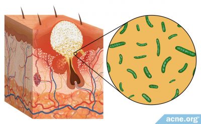 The Role of Bacteria in Acne