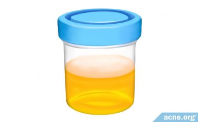 Urine Therapy for Acne