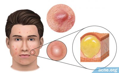 What Is an Acne Cyst?