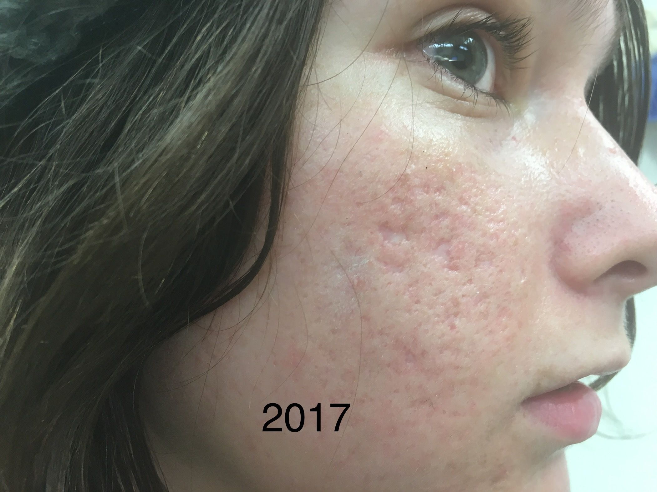 CO2 laser in treating acne scars ultrapulse & Subcision of Acne Scars