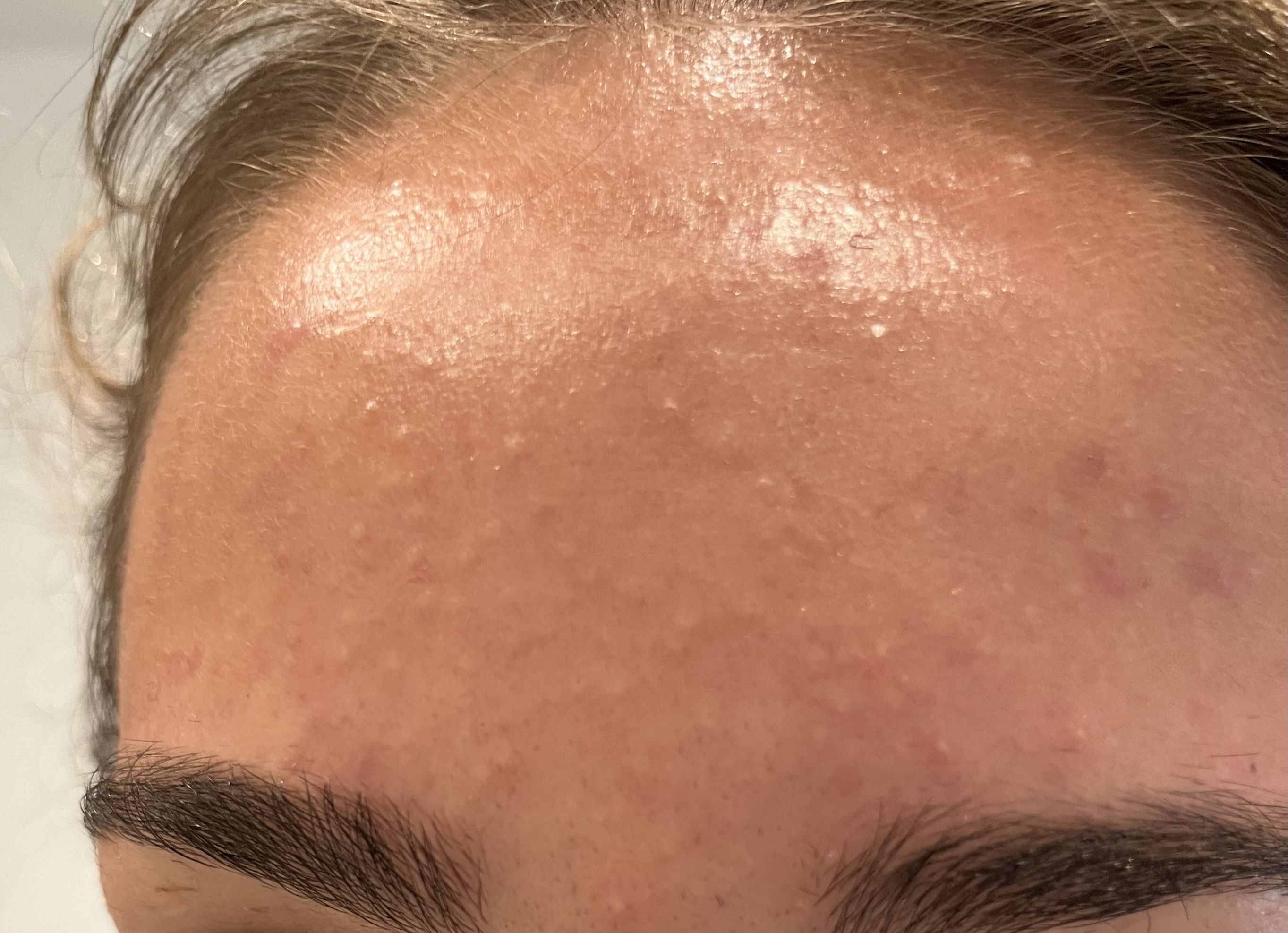 Comedonal acne or Fungal acne?! - General acne discussion - Acne.org