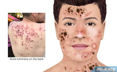 What Is Acne Fulminans?