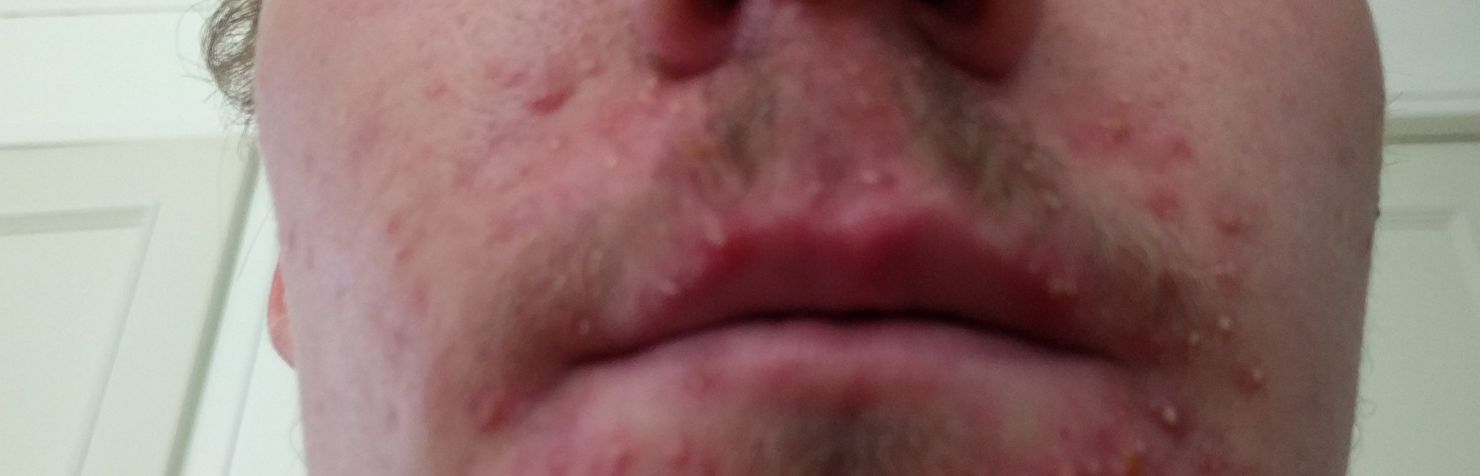 1485294615_morepustules.jpg.bc07886787c033e7de775db3022b7e64.jpg