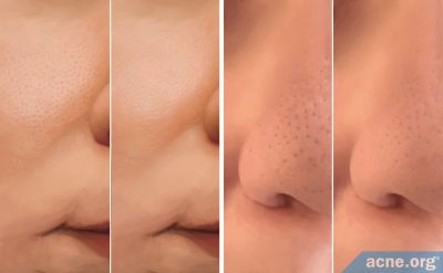 Can You Reduce the Size of Your Skin Pores?