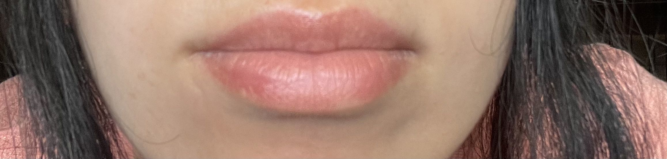 help-with-deep-indented-scar-on-corner-of-mouth-scar-treatments