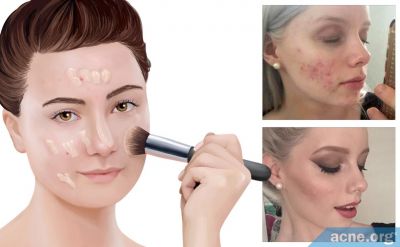 Does Makeup Help with Self-esteem When You Have Acne?