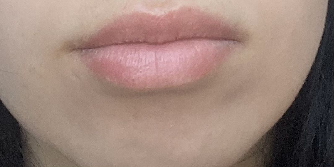 help-with-deep-indented-scar-on-corner-of-mouth-scar-treatments