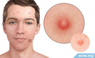The Role of Inflammation in the Development of Acne