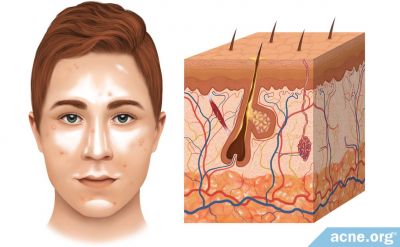The Role of Sebum (Skin Oil) in Acne