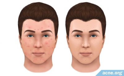 What Is the Difference Between Inflamed and Non-inflamed Acne?