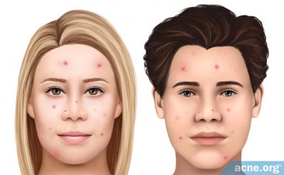 White Skin and Acne
