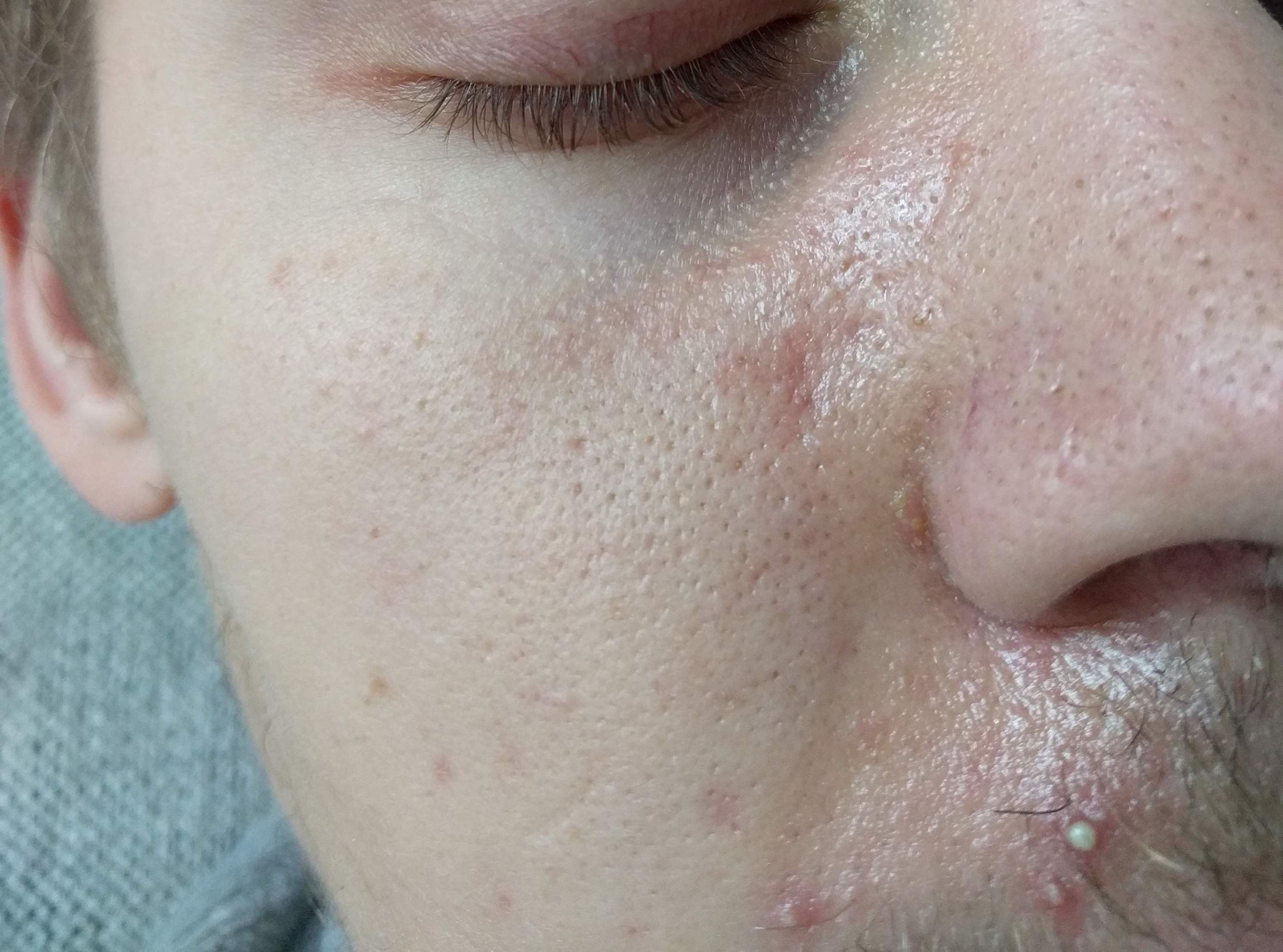 pustules.jpg.48506426273dead90fcd46493acc96de.jpg
