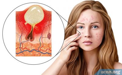 Exactly How Does Acne Form Now That Scientists Believe It Is Primarily Inflammatory?