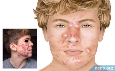 What Is Acne Conglobata?
