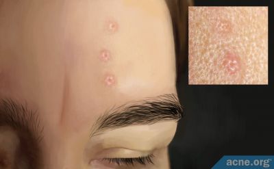 What Is Sebaceous Hyperplasia, and Is It the Same as Acne?