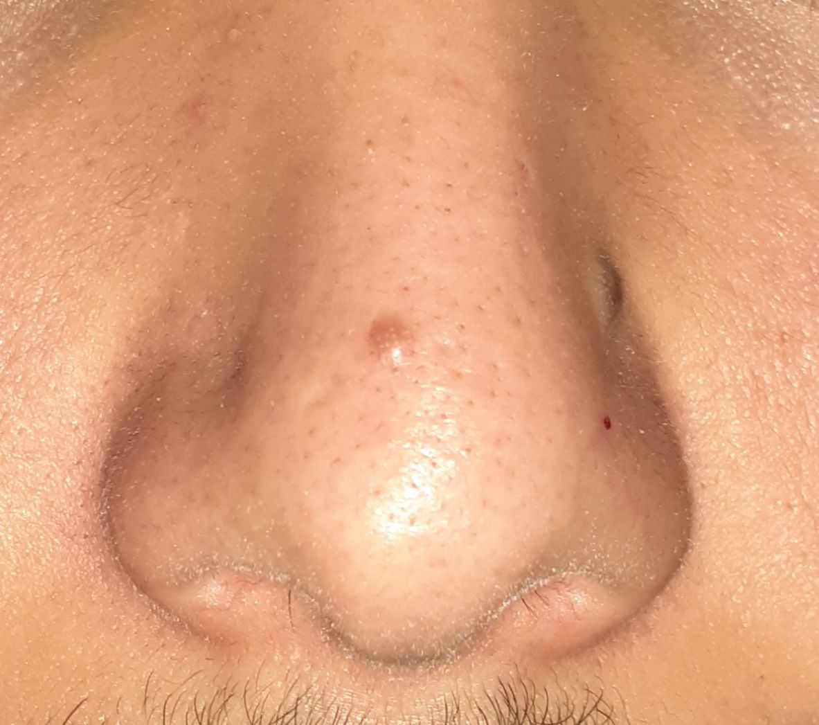 a-pimple-that-lasted-for-2-years-general-acne-discussion-acne-forum