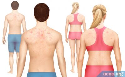 Who Gets Body Acne More--Males or Females?