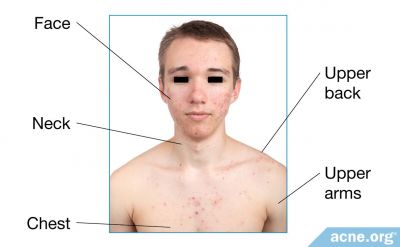 Why Do People Get Acne Mostly on the Face and Upper Body?