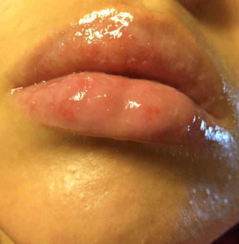 Lips very tiny bumps on Causes of