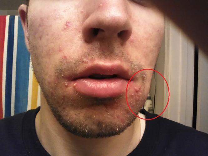 to accutane reactions bad