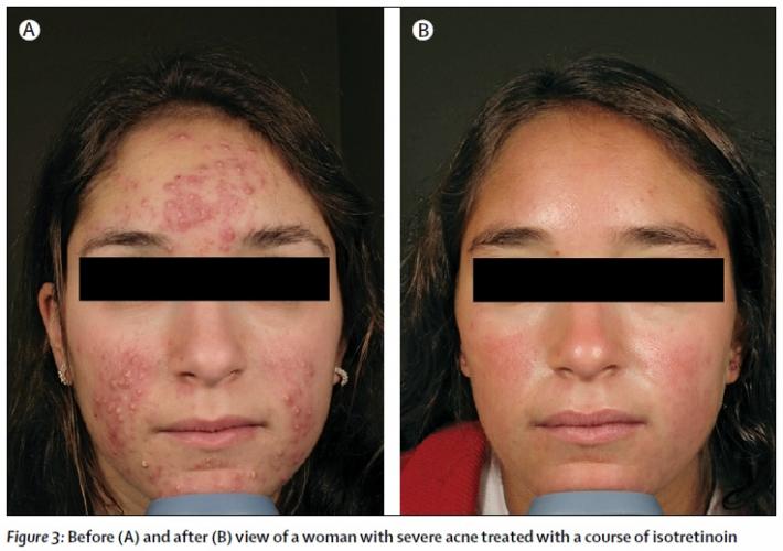 treatment dry skin after accutane