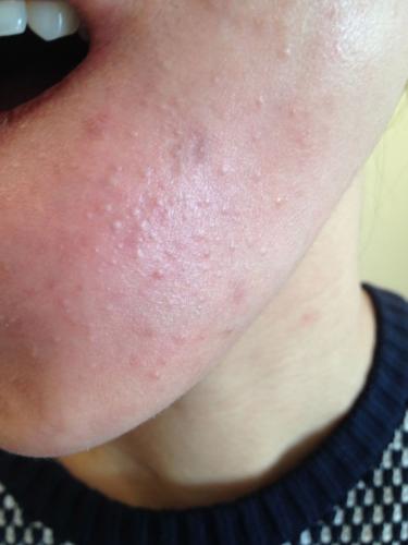 Stubborn Closed Comedones Hormonal acne Acne Forum