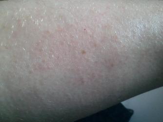 red bumps on arms accutane