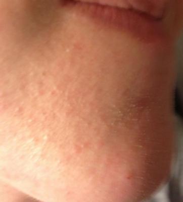 clogged pores bumps
