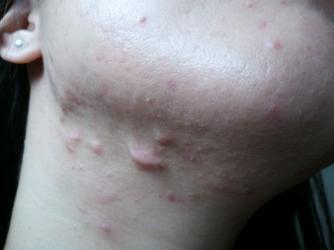 Steroid injection for acne scar