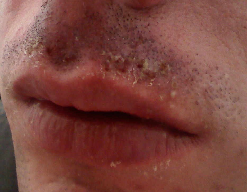 Need Help Identifying This Skin Rash Infection Rosacea And Facial