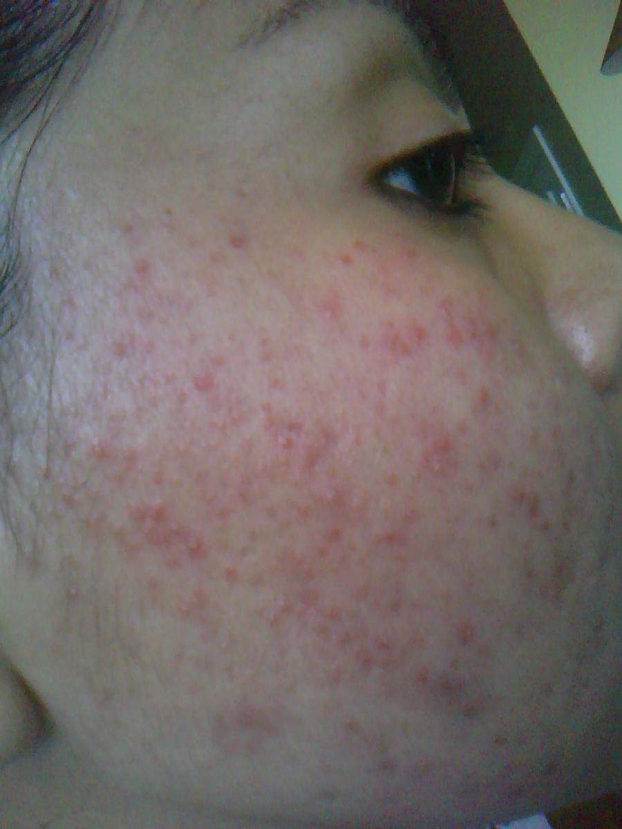 Rash Cluster And Redness Pics Help Me Make It Better 