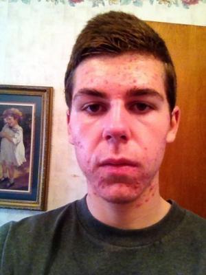 third time accutane taking