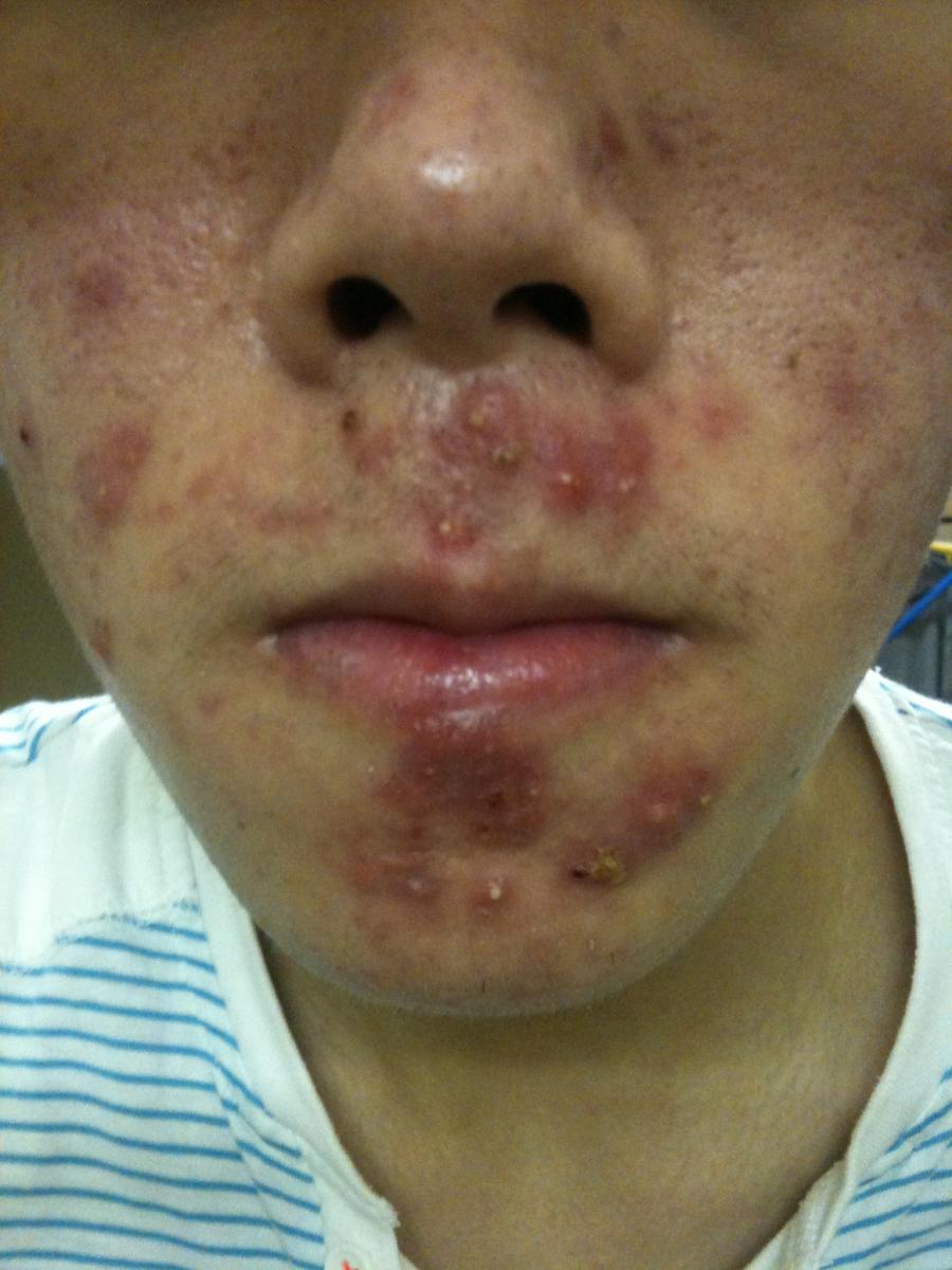 can-my-cystic-acne-go-away-in-10-days-general-acne-discussion-acne