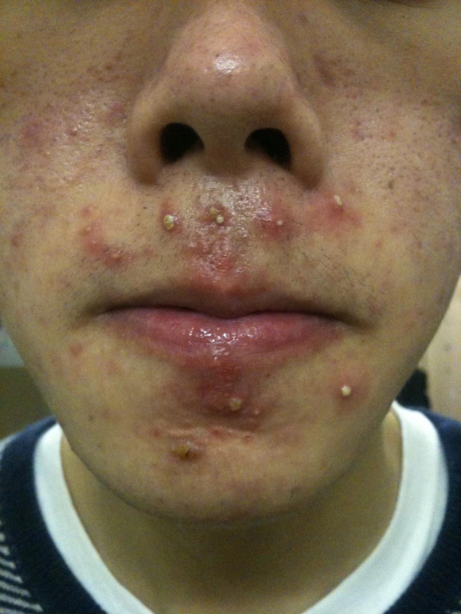 can-my-cystic-acne-go-away-in-10-days-general-acne-discussion-by