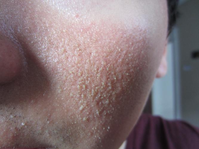 Post-Accutane Kp , A  supreme Dry Skin Disease. Picture  