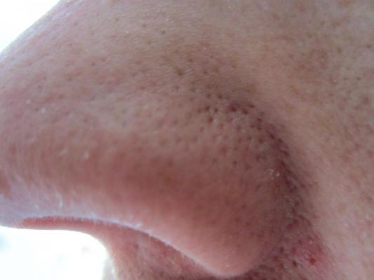 Blackheads Open Pores On Side Of Nose Pics General Acne