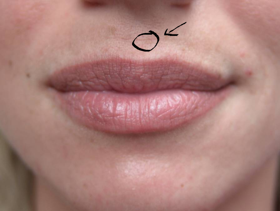 cold-sore-or-pimple-how-to-tell-what-the-bump-on-your-lip-really-is