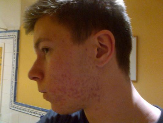 How To Get Rid Of Red Marks On Accutane 