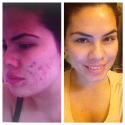 Acne Org Regimen Before And After The Acne Org Regimen Acne Org