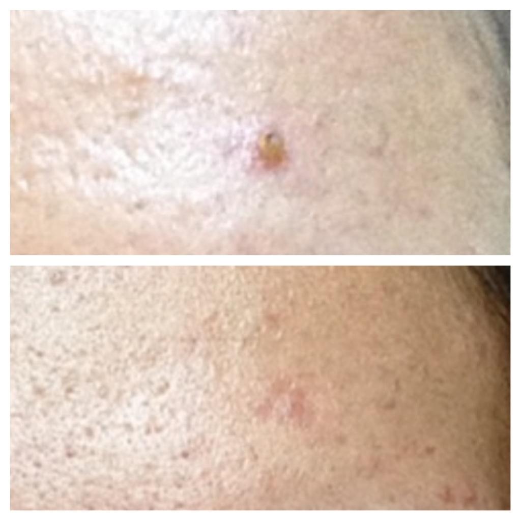 Huge Clogged Pore Pictures General Acne Discussion Community